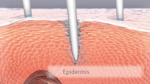 Read more about the article Microneedling – Funktion