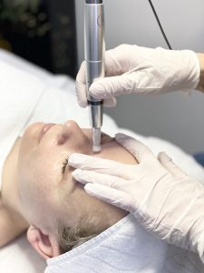 Read more about the article Microneedling MesoSono – Nach der Behandlung
